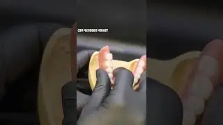Зубной протез на имплантах- балочная конструкция. 