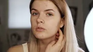 best acne treatment for teenage girl home remedy