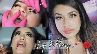 I GOT LIP INJECTIONS!! MY LIP FILLER EXPERIENCE + Q&A