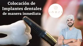Implantes de manera inmediata