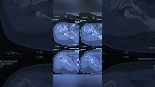 Best Surgery for Shoulder Dislocation with Bone Loss  : arthroscopic scapular spine bone block