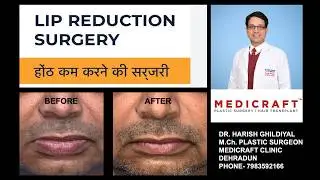 LIP REDUCTION I होटों को पतला करने की सर्जरी COST OF LIP REDUCTION SURGERY IN DEHRADUN I