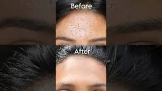 How to Get Rid of Tiny Bump in 30 Days✨ #Shorts #sristydutta #clearskin #acne #tinybumps #glassskin