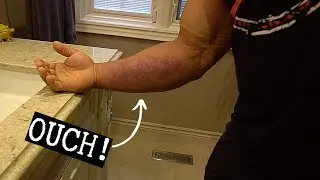 Bicep tear : it looks pretty messed up now!