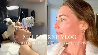 My PRP microneedling experience | Unboxing new YouTube lighting |  Melbourne Vlog