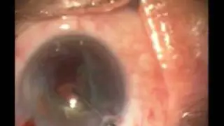 Facoemulsificación de catarata con pérdida de vítreo durante extracción del núcleo