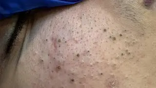 Say Goodbye to Clogged Pores! 7 Deep Cleansing Techniques!