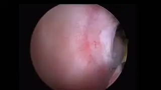 Operative vaginoscopy, transverse vaginal septum by Osama Shawki