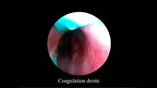 Turbinectomie inférieure par Electro coagulation bipolaire sous Anesthésie Locale