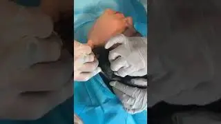 Viola Threads Double Chin Treatment Tutorial