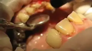 מכשיר לייזר לרופא שיניים