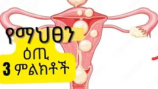 የማህፀን እጢ 3 ምልክቶች እና ህክምና/የማህፀን ካንስር/Uterine fibroids, Symptoms and Management Option