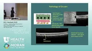 Age Related Macular Degeneration - Chapters 4, 5, 6, 12 [ARCHIVE]