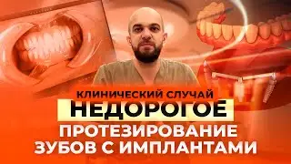 Недорогое протезирование зубов с имплантами. Клинический случай