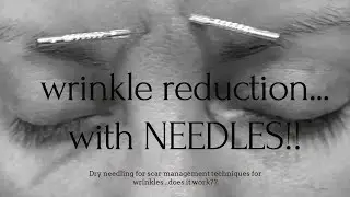 Wrinkle Reduction...With Needles!?