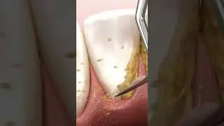 deep teeth cleaning 