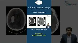 Acute Ischemic Stroke
