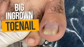 Ingrown Toenail Removal