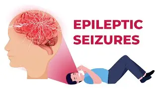 Epileptic Seizures Explained (and How to Help Someone Having One)