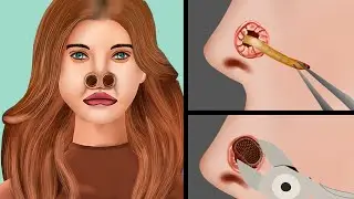 ASMR Suffering from Nose Blockage Treatment - Cleaning Of Large Swollen Nose Plugs | JINJJA 진짜 ASMR