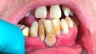 10+ Years of Dental Neglect & Bone Loss: What Can Be Done?
