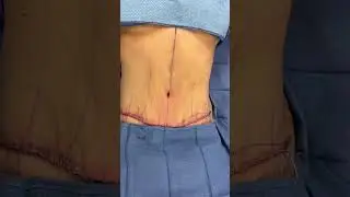 Tummy Tuck and Umbilical Hernia Repair in Mother of Three! 