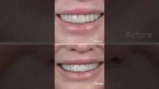 Replacing these large, bulky, and unnatural veneers #readdescription #veneers #dentist
