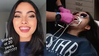 GETTING BRACES ON VLOG!! PT. 1