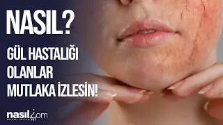 GÜL HASTALIĞI NEDİR? GÜL HASTALIĞI NASIL GEÇER? İŞTE DOĞAL ETKİLİ YÖNTEMLER! 