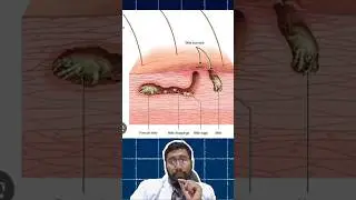 🦠 Parasites That Burrow Into Your Skin and Lay Eggs: SCABIES! 🤯✨ 