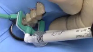 ICON resin infiltration