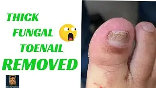 Total Toenail Removal Before & After
