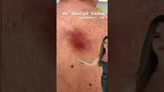 Infected cyst #skincare Dr Khaled Sadek