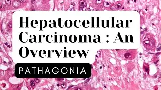 Hepatocellular Carcinoma: Overview #pathagonia