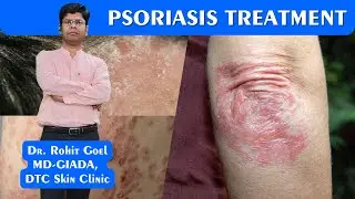 Psoriasis Treatment Patient Review 2 | Dr. Rohit Goel