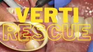 VERTICAL PREPARATION TO THE RESCUE