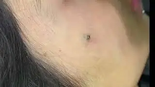 remoção de piercing microdermal