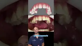 Can Invisalign Fix My Bite and Straighten My Teeth? 2023