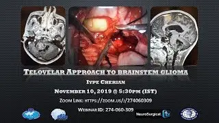 Telovelar Approach to Brainstem Glioma