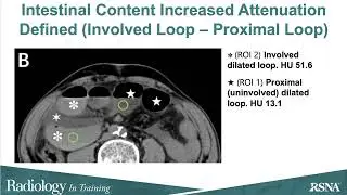 Increased Attenuation of Intestinal Contents at CT Indicates Bowel Necrosis in Closed-Loop SBO