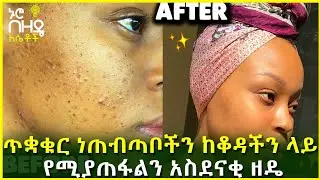 Ethiopia : ጥቋቁር ነጠብጣቦችን ከቆዳችን ላይ የሚያጠፋልን አስደናቂ ዘዴ | Nuro Bezede Girls