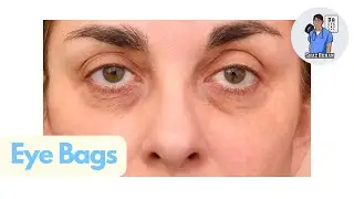 Dr Eye For You Explains How to Get Rid of Under EYE BAGS