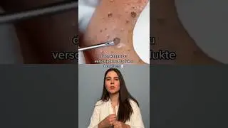 Blackhead removal 😱 