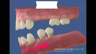 Неполный зубной ряд титры