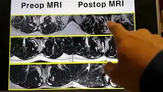 The Changes of Back Muscles after Laminotomy: Review of cases and lesson
