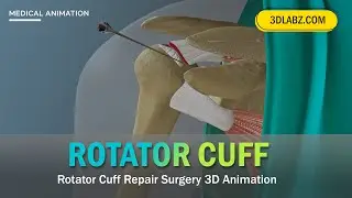 Rotator Cuff Repair Surgery 3D Animation | Shoulder Surgery Animation | Rotator Cuff Tear