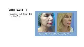 Mini Facelift vs. Full Facelift: Which is Best for You? #FaceliftSurgery