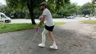 Man toeplate long leg cast, llc in home and crutching around city - 3 days adventure