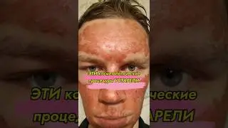 ОПАСНО! Не дай косметологу делать это с тобой! // #докторщербатова