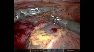 Thymic Cyst